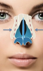 Dorsal hump highlighted in blue